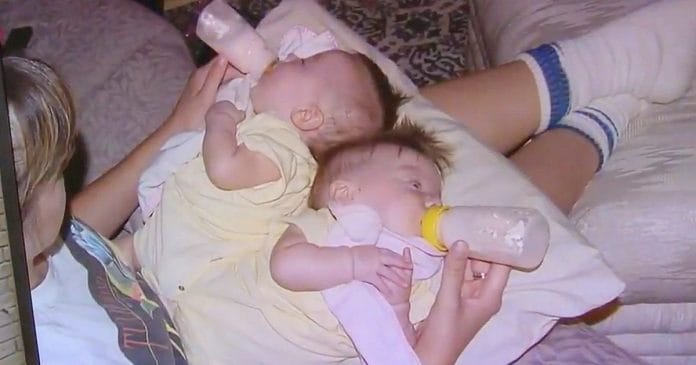 7 hónaposan életveszélyes műtétet hajtottak végre a sziámi ikerpáron, ma már 17 évesek!