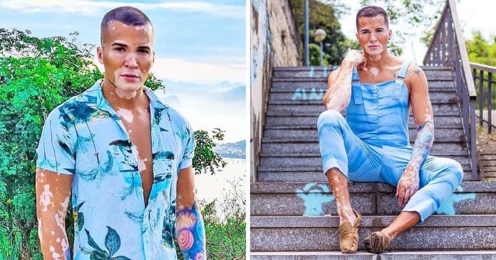 Roger 10 éven át rejtegette a bőrhibáját, most büszkén mutatja meg vitiligo-borította testét!