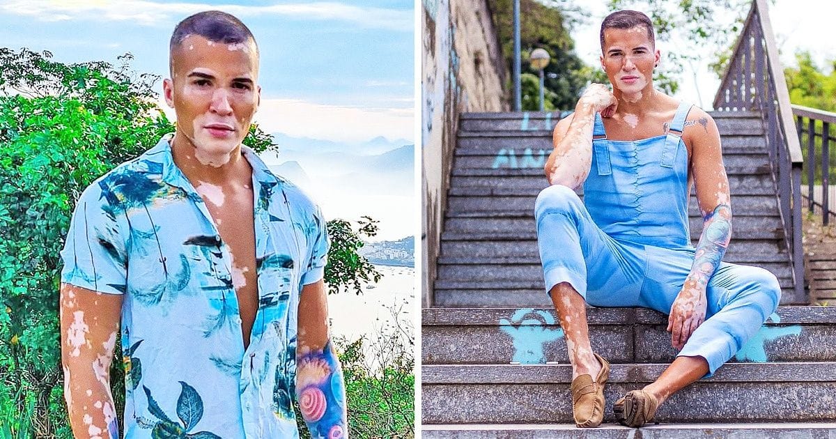 10 éven át rejtegette a bőrhibáját, most büszkén mutatja meg vitiligo-borította testét!