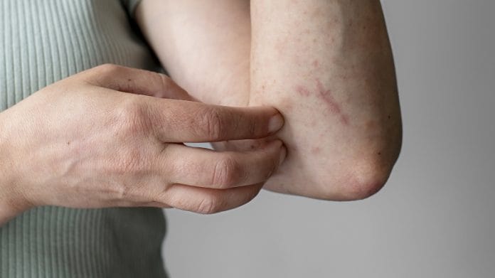 Ezekkel az otthoni szerekkel enyhítheted viszkető bőröd